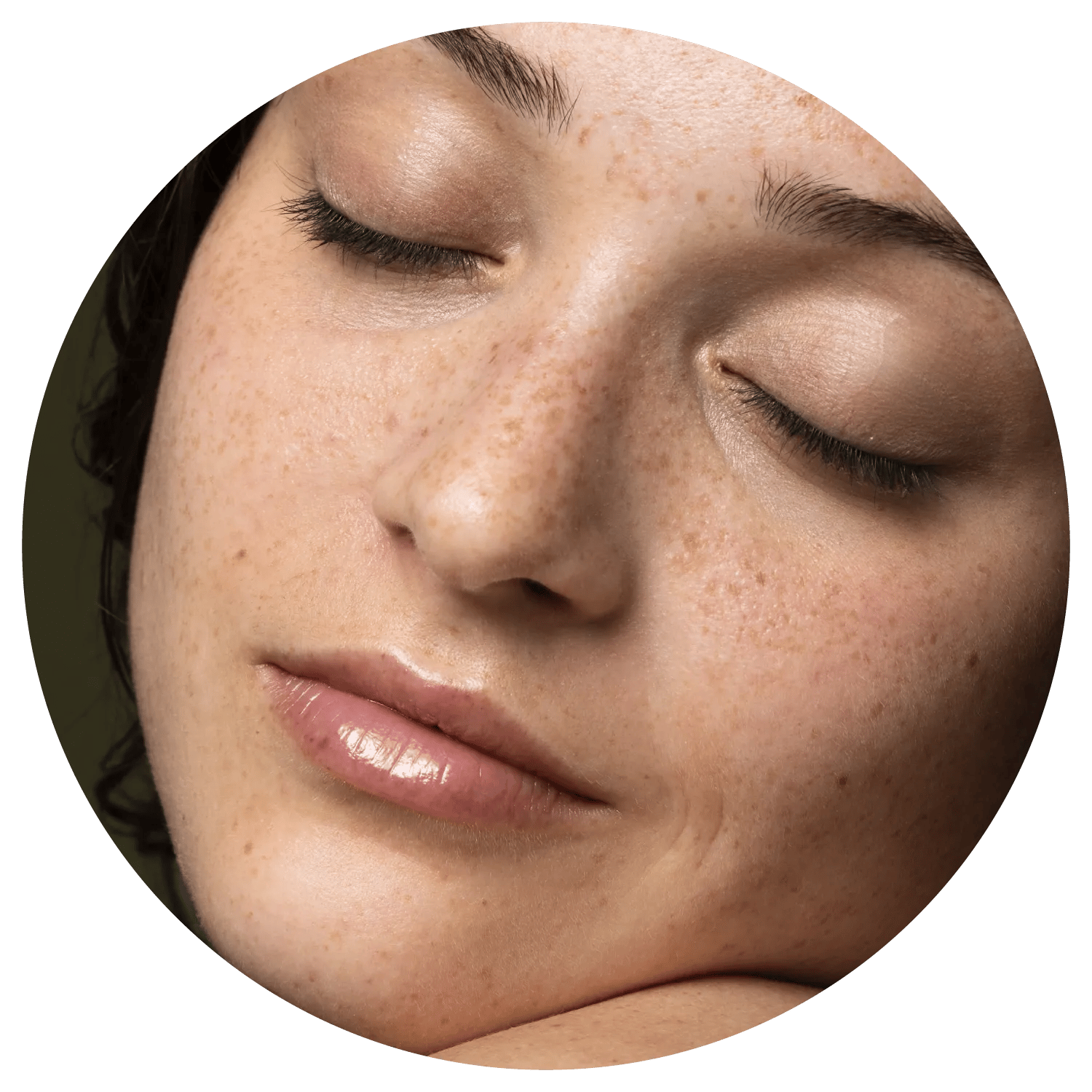 Age Spots treatment results at Toronto medical spa - The Chain Reaction of Symptoms